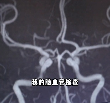 45歲三甲醫院腦梗專家自己腦梗了