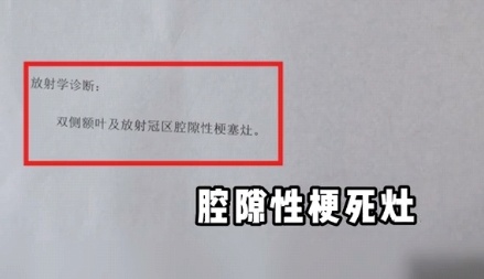 45歲三甲醫院腦梗專家自己腦梗了